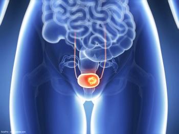 3D rendered illustration of bladder cancer
