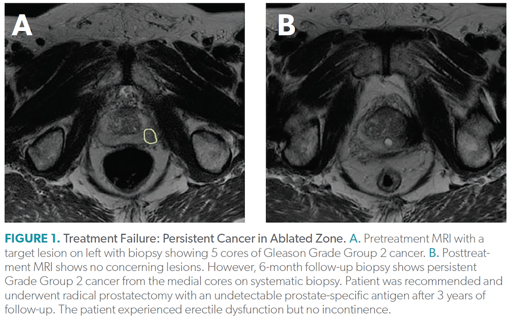 Management Of Recurrent Prostate Cancer After Focal Therapy