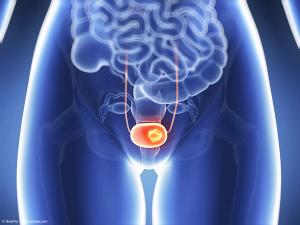 3d rendered illustration of bladder cancer | Image Credit: © SciePro - stock.adobe.com