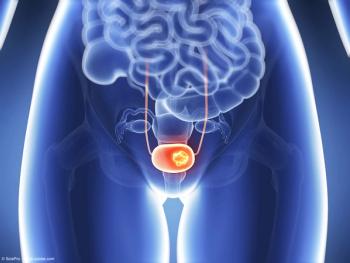 3d rendered illustration of bladder cancer | Image Credit: © SciePro - stock.adobe.com