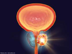 RP appears more effective against high-risk prostate cancer