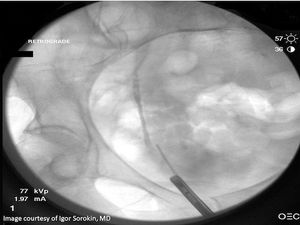 Quiz: Retrograde pyelogram for positive cytology