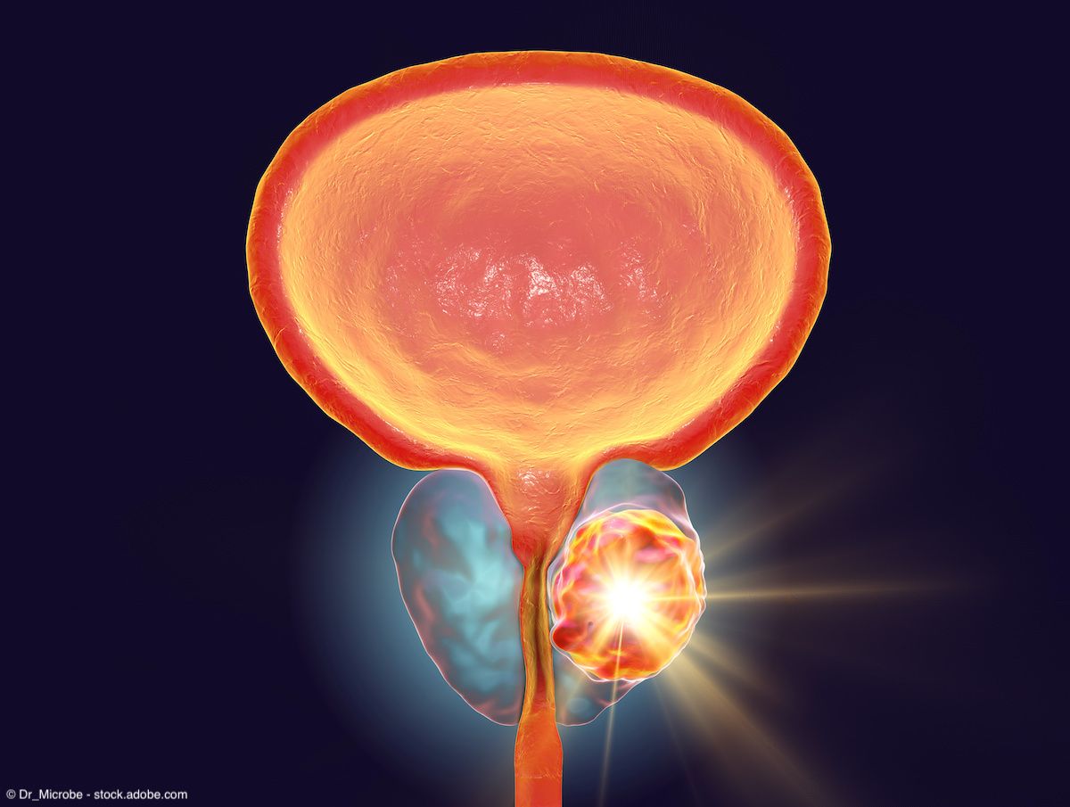 Radioligand therapy shows promising safety in patients with mCRPC