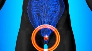 Dr. Markowski on phase 3 trial of sabizabulin (VERU-111) in mCRPC