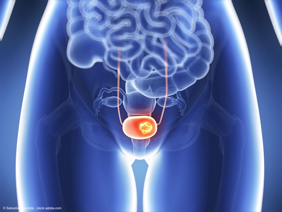 3d rendered illustration - bladder cancer | Image Credit: © Sebastian Kaulitzki - stock.adobe.com