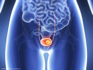 3d rendered illustration - bladder cancer | Image Credit: © Sebastian Kaulitzki - stock.adobe.com
