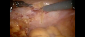 Robotic suprapubic simple prostatectomy: Step-by-step approach