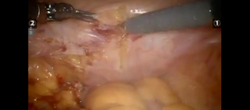 Robotic suprapubic simple prostatectomy: Step-by-step approach