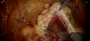 Robotic simple suprapubic prostatectomy for large prostatic adenoma