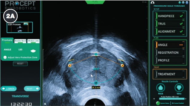 Photo courtesy of PROCEPT BioRobotics