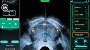 Photo courtesy of PROCEPT BioRobotics