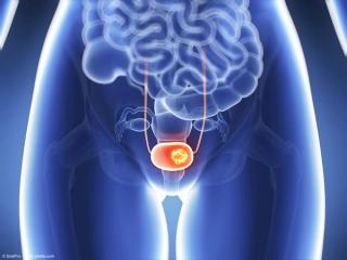3d rendered illustration of bladder cancer | Image Credit: © SciePro - stock.adobe.com
