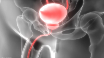 clinical rendition of bladder cancer on an x-ray