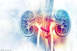 Tool seeks to aid in decision between shock wave lithotripsy and URS in kidney stones