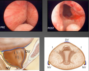 Urethral lift (UroLift): A new standard for BPH?