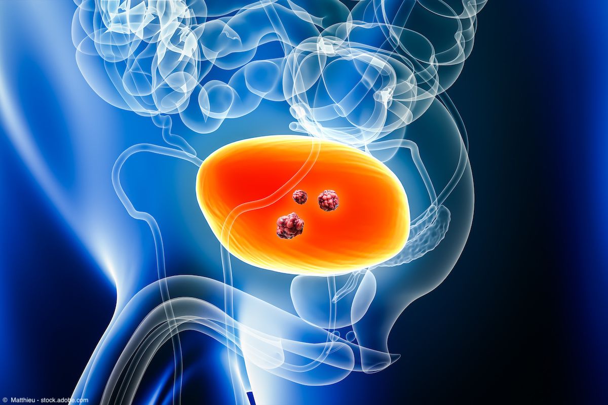 Urinary bladder cancer | Image Credit: © Matthieu - stock.adobe.com