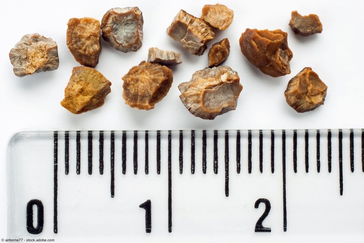 Kidney stones | Image Credit: © airborne77 - stock.adobe.com