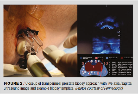 Biopsy on prostate