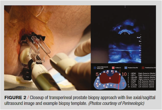 prostate biopsy technique