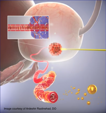 Image courtesy of Ardeshir Rastinehad, DO