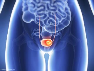 3d rendered illustration of bladder cancer | Image Credit: © SciePro - stock.adobe.com
