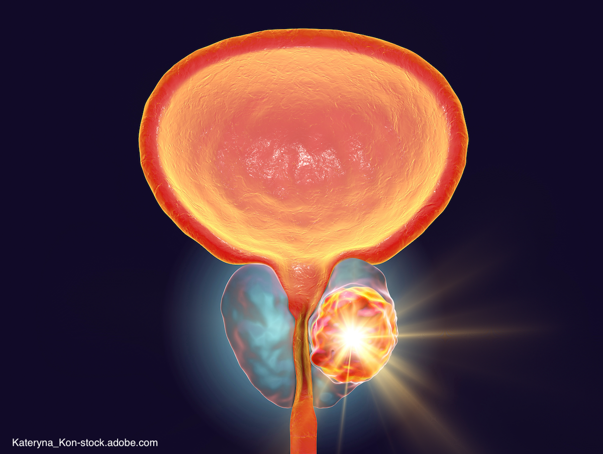 Novel abiraterone formulation succeeds in phase 3 prostate cancer trial