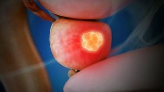 Dr. Andriole discusses targeted therapies in men with prostate cancer who demonstrate BCR