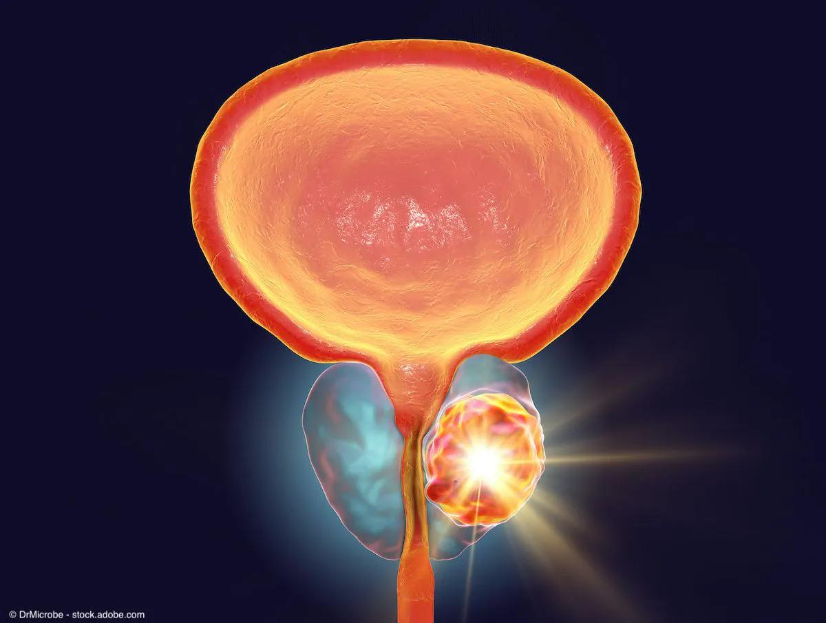 “The antitumor effect of 225Ac-PSMA RLT in mCRPC is influenced by several factors, including previous treatment with taxane-based chemotherapies and the pattern of mCRPC metastases. These factors should be considered in selecting patients for 225Ac-PSMA RLT," the authors wrote.