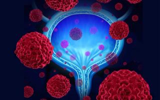 Dr. Wang on personalized treatment selection in relapsed/refractory urothelial carcinoma