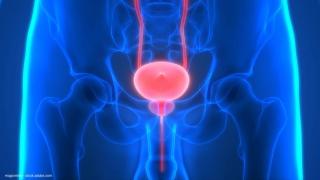 Dr. Stover discusses research on UGN-102 in non–muscle-invasive bladder cancer