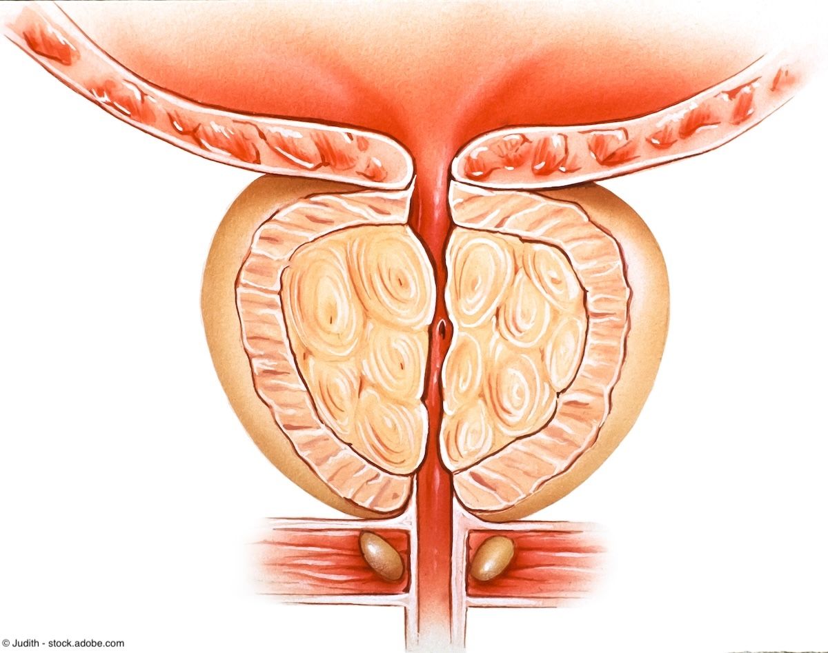 Benign Prostatic Hyperlasia | Image Credit: © Judith - stock.adobe.com