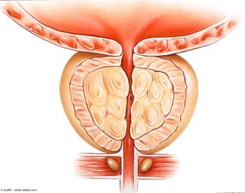 Benign Prostatic Hyperlasia | Image Credit: © Judith - stock.adobe.com