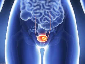 Bladder Cancer