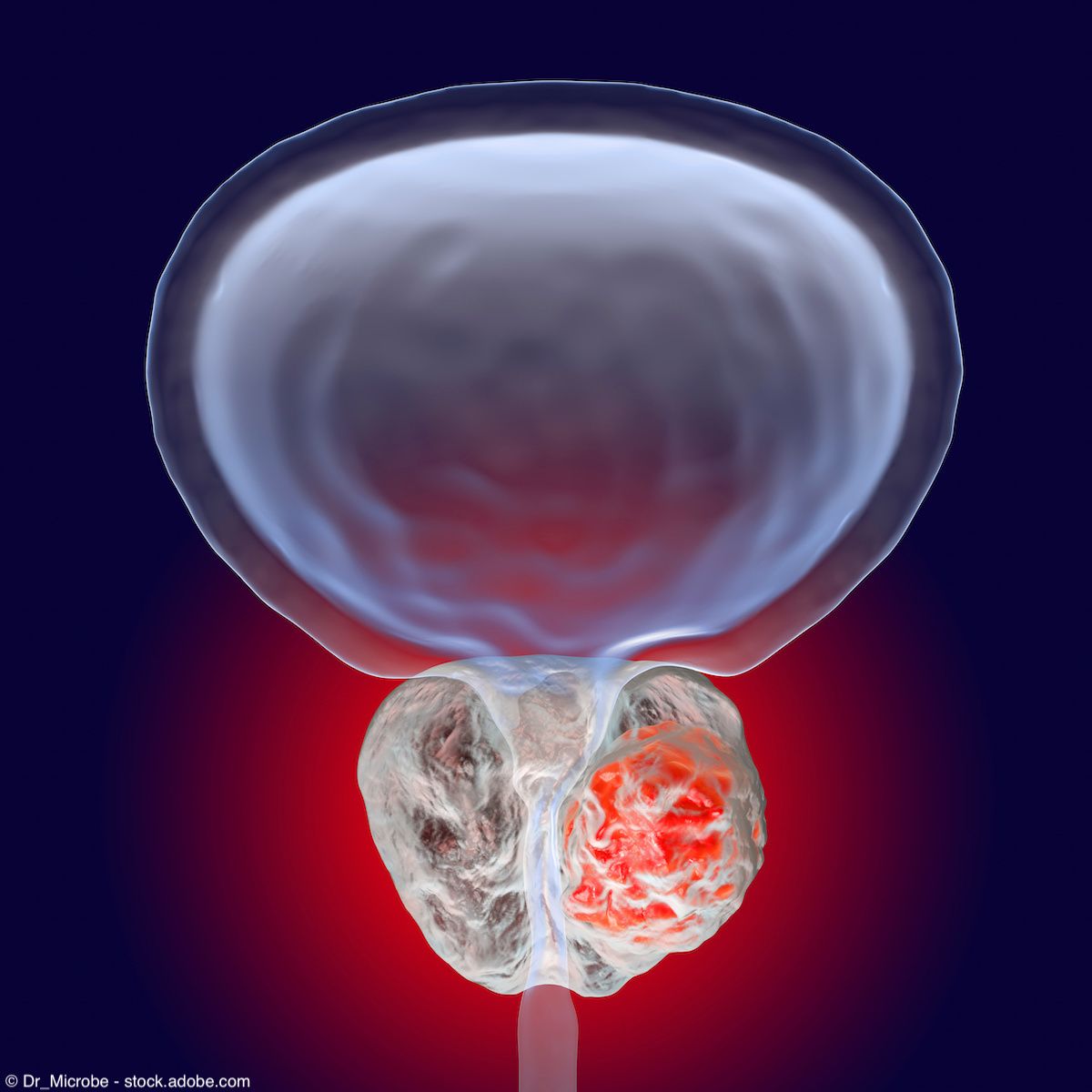 Prostate cancer, 3D illustration showing presence of tumor inside prostate gland which compresses urethra | © Dr_Microbe - stock.adobe.com