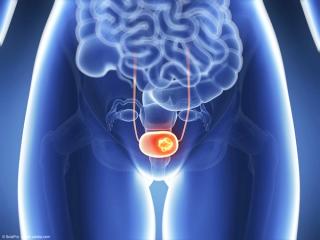 illustration of bladder cancer
