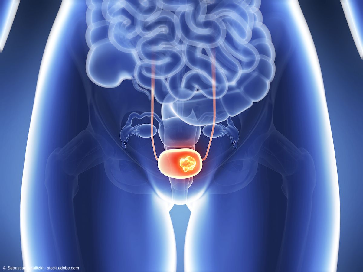 3d rendered illustration - bladder cancer | Image Credit: © Sebastian Kaulitzki - stock.adobe.com