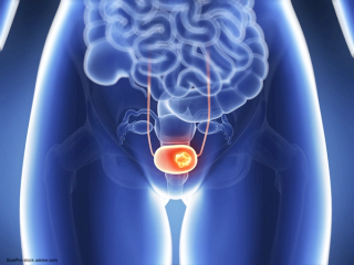 3D rendition of bladder cancer