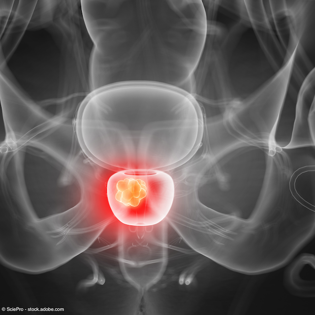 Los resultados iniciales son prometedores para 64Cu SAR-Bombesin en el cáncer de próstata