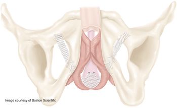Image courtesy of Boston Scientific