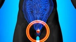 Novel imaging agent explored in patients with PSMA-negative prostate cancer