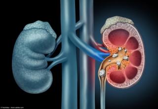 Human kidney Stones Medical Concept | Image Credit: © freshidea - stock.adobe.com