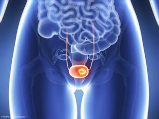 3d rendered illustration - bladder cancer | © SciePro - stock.adobe.com