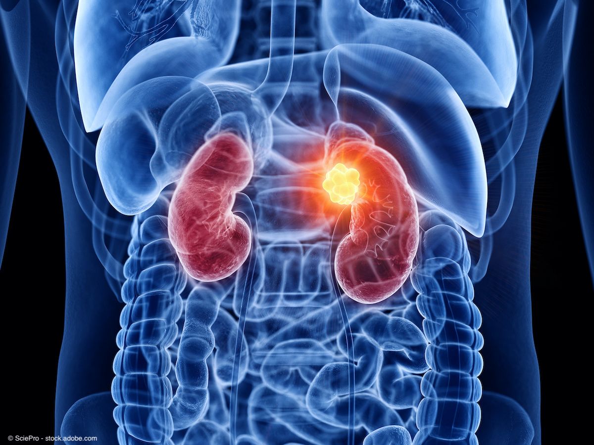 illustration of kidney cancer
