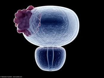 3d rendered medically accurate illustration of a bladder tumor | Image credit: © Sebastian Kaulitzki - stock.adobe.com