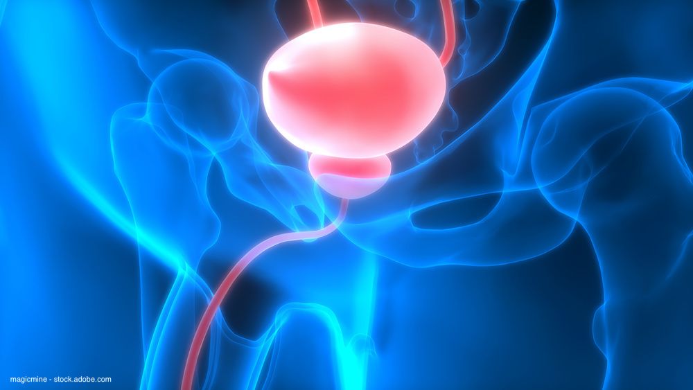 Antibody-drug conjugates make splash in bladder cancer ...