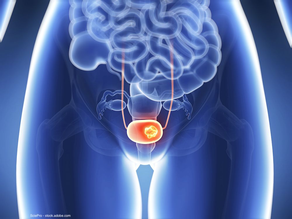 Non–muscle-invasive bladder cancer: The revolution is here