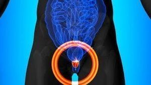 Expert highlights the latest radiotherapy developments in prostate cancer