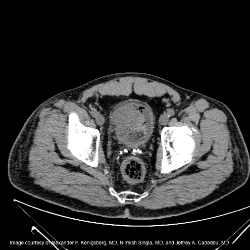 Challenging case: Hematuria in man with a history of prostate Ca