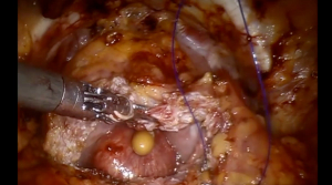 Patient selection, key steps for robotic simple prostatectomy