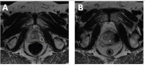 Management of recurrent prostate cancer after focal therapy